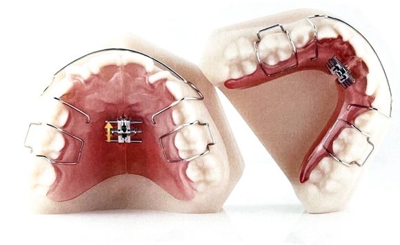 稲沢市グランツ歯科室の床矯正装置の写真